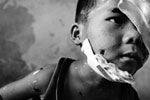 Um menino de seis anos que perdeu o olho esquerdo após encontrar uma munição de fragmentação perto de sua casa no Laos. © 2005 Andrew McConnell/WpN