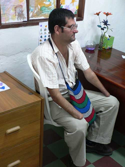 Edilberto Prada Ardila, a 46-year-old man who lost an eye and his hands to a landmine