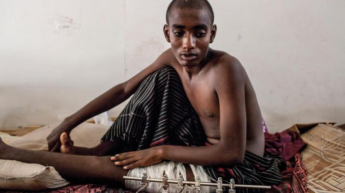 Ethiopian migrant, 19, at a local medical facility in Haradh. He said he was tortured for a month and shot in the leg by traffickers trying to extort money from family members abroad, May 2013.