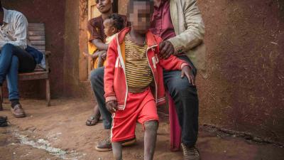 A 6-year-old boy, born near Lega Dembi gold mine in the Oromia region of Ethiopia, has no bones in his right foot and three toes on his left foot. 