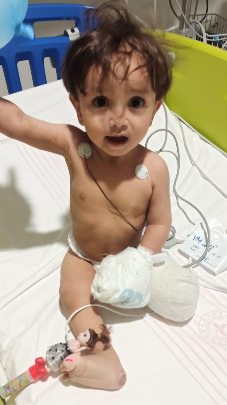 A baby with an amputated leg sitting up in a hospital bed