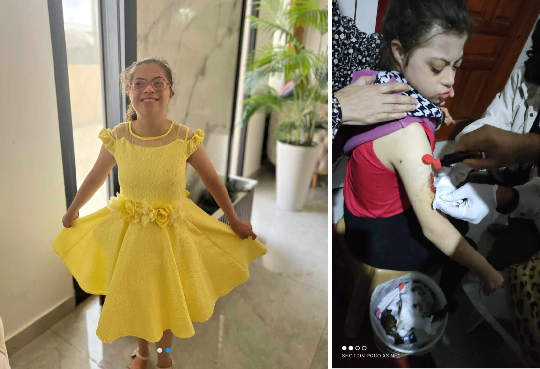 (Left): Nour Ghandour, 14, who has Down syndrome, in a photo taken prior to October 7, 2023. (Right): Nour a month following the injury, having her wound cleaned.