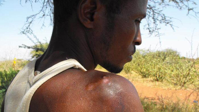 Maash Hussein Abikar shows scars left by Kenyan soldiers when he was beaten with a gun butt during a round-up of ethnic Somalis in Wajir in December 2011. He also lost two teeth and now has blurry vision in one eye as a result of the beating.