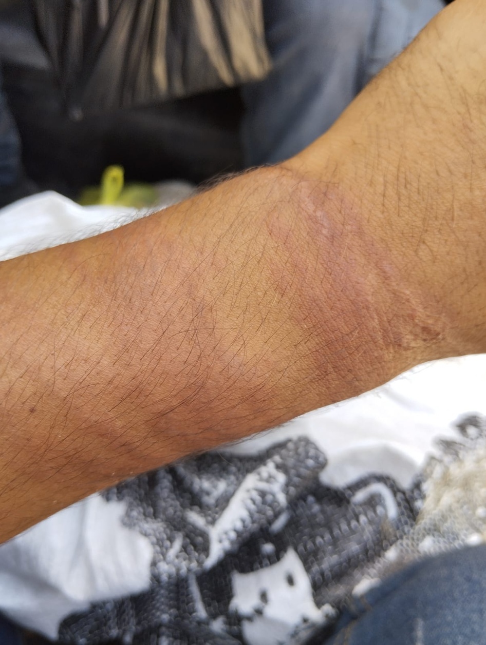 Visible marks on Walid Khalili’s wrists from prolonged hand cuffing with zip ties and metal cuffs. Khalili said these scars are from Israeli soldiers suspending him from a chain connected to cuffs on his hand as well as dragging him by the hands on the ground. Photo taken around April 8, 2024, after Khalili’s release from Israeli detention.